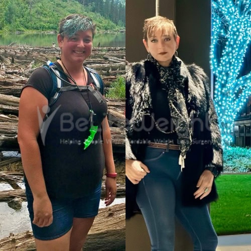 Weight Loss Surgery Before and After